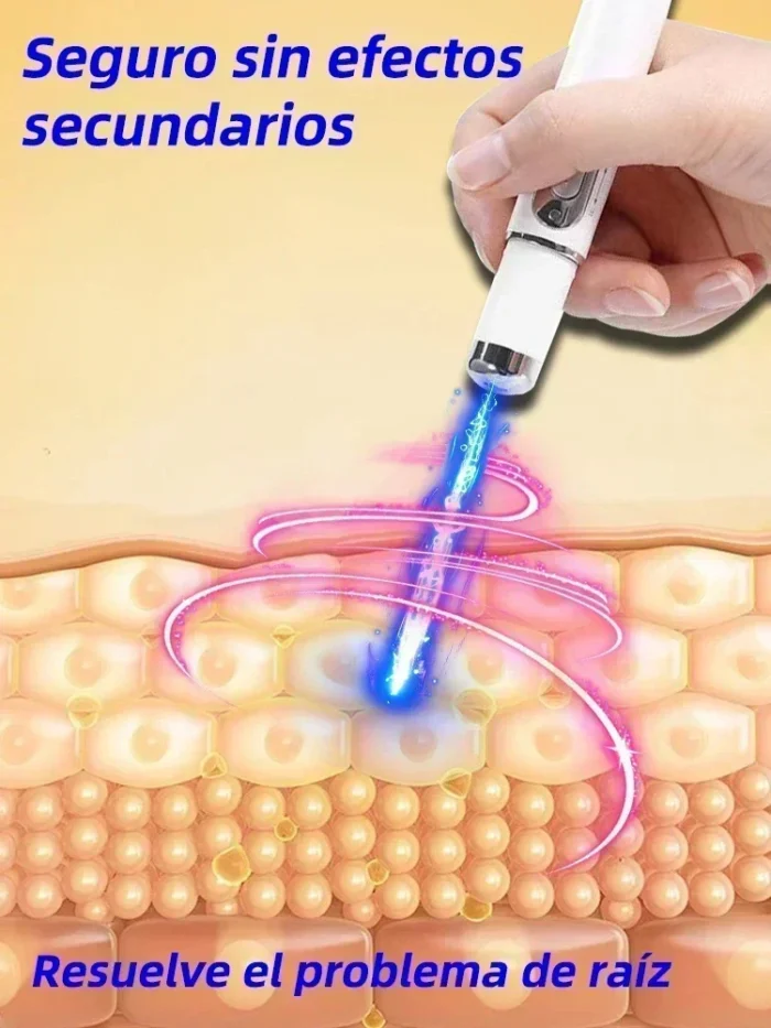Laser Therapy Keloid Scar Improve Keloid Scar Pen Scar Relief Easy Harmless Laser Pointer - Image 2